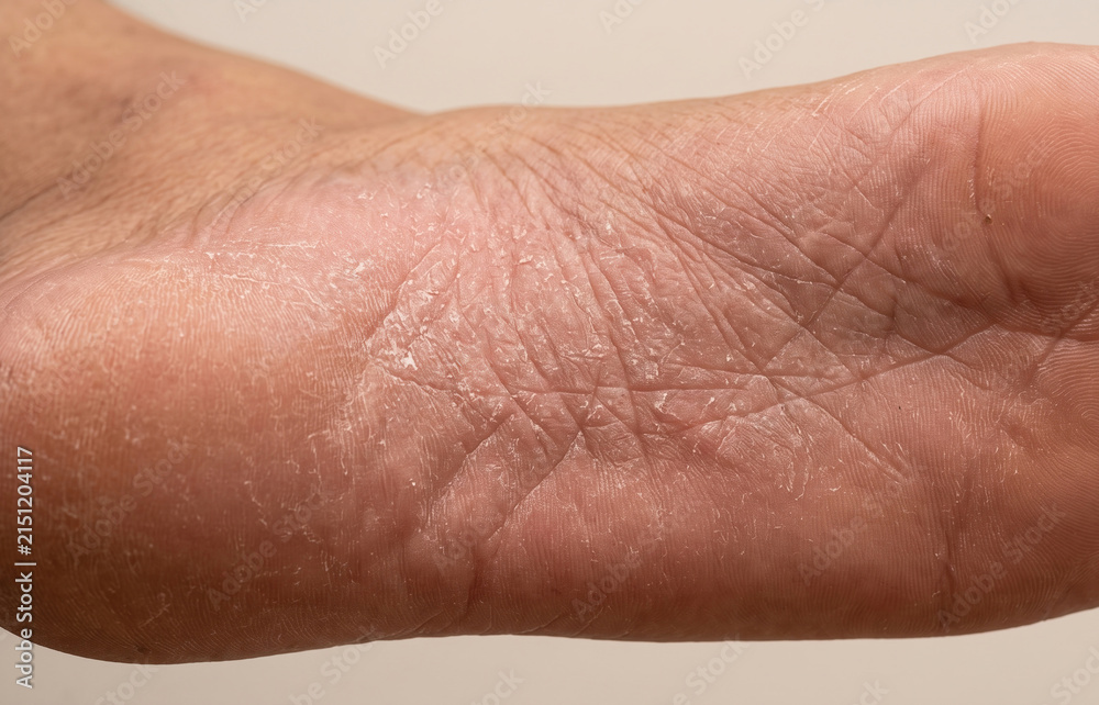 Fototapeta premium Close Up of Dry Peeling Skin and Fungal Infection on Sole of Foot
