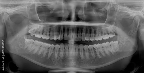 Cuadro en lienzo Full dental x-ray shows both upper and lower jaws