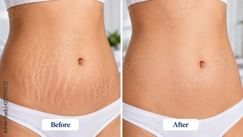 Stretch marks reduction on female stomach skin before and after laser therapy treatment comparison.
