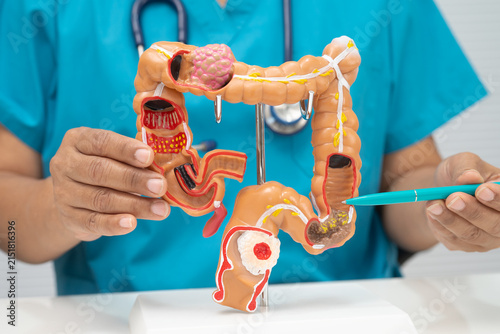 Принти на полотні Colorectal cancer, doctor holding intestine colon human anatomy model
