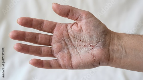 Dry cracked hand skin texture close up medical dermatology condition