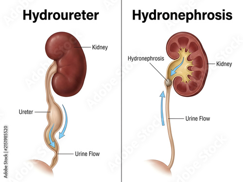 Hydroureter and hydronephrosis medical illustration comparison isolated on white background