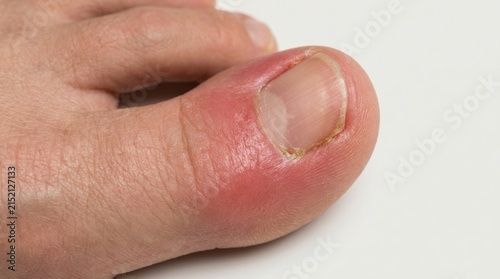 Inflamed big toe with paronychia infection or ingrown toenail on white background