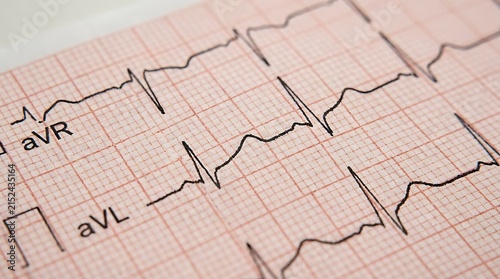 Close up of an electrocardiogram printout showing heart rate rhythm for medical diagnosis