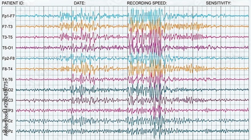 Medical EEG Brain Wave Analysis Report Showing Abnormal Electrical Activity on Grid Paper