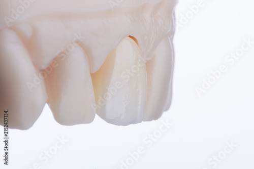 Cuadro en lienzo Mirror copy of central maxillary incisor, ultra thin dental ceramic veneer or cr