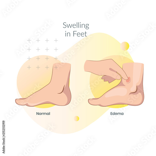 Normal Foot vs Edema Foot with Swelling and Fluid Retention - Stock Illustration as SVG File