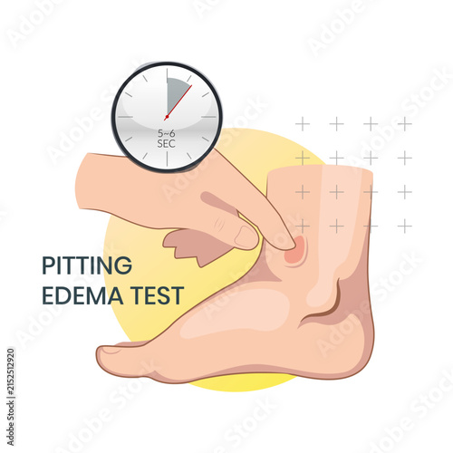 Pitting Edema Foot with Swelling and Fluid Retention - Stock Illustration as SVG File