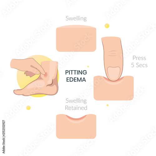 Pitting Edema Foot with Swelling and Fluid Retention - Stock Illustration as SVG File
