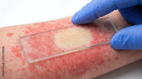 Glass slide test dioscopy demonstrating blanching erythema rash on human forearm skin