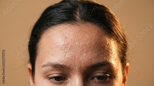 Close up of young woman forehead affected by severe closed comedones fungal acne bumps