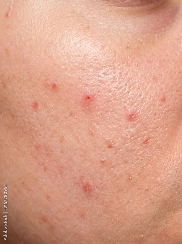 Fototapeta premium Detailed macro potrait of human facial skin texture with visible red acne for dermatological research, skincare marketing, and medical education.