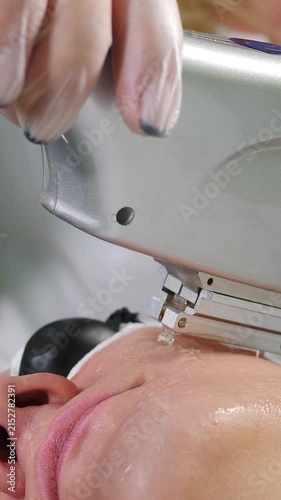 Intense pulsed light device applied to female chin and cheek. Gloved hands hold silver metal machine. Facial skin for aesthetic laser skin rejuvenation and anti-aging treatment. vertical 4k shot