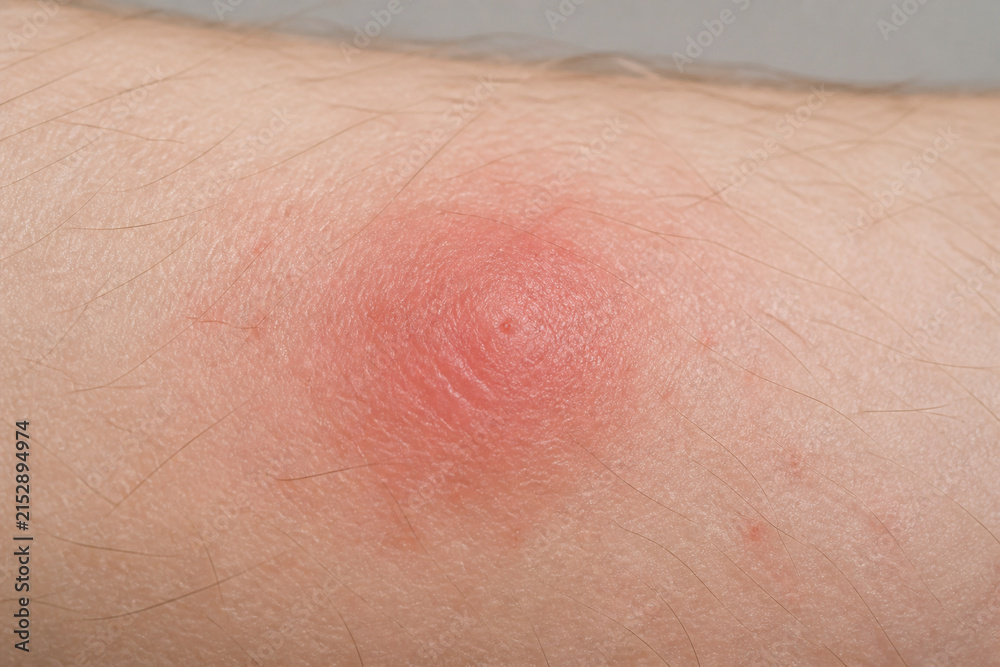Fototapeta premium Red swollen mosquito bite on forearm skin, insect bite irritation and allergy