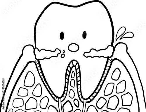 Foto Gingivitis