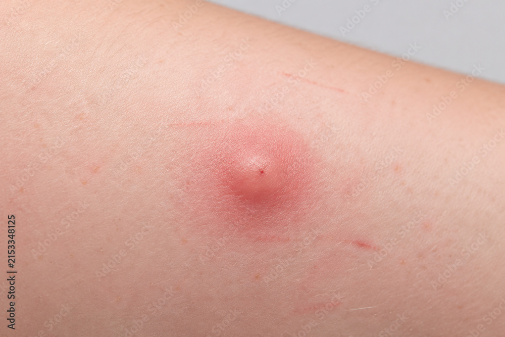 Fototapeta premium Red swollen mosquito bite on forearm skin, insect bite irritation and allergy