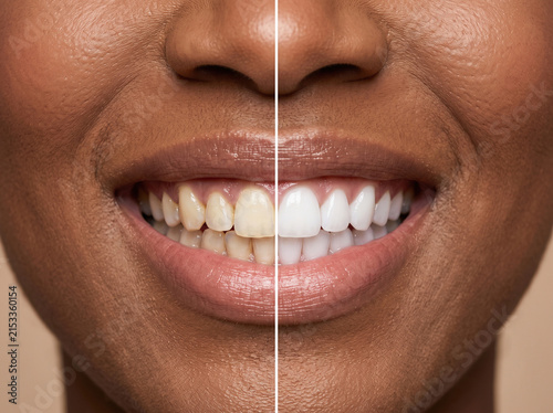 Sorriso Feminino Mulher Negra Clareamento Dental e Lentes em Resina
