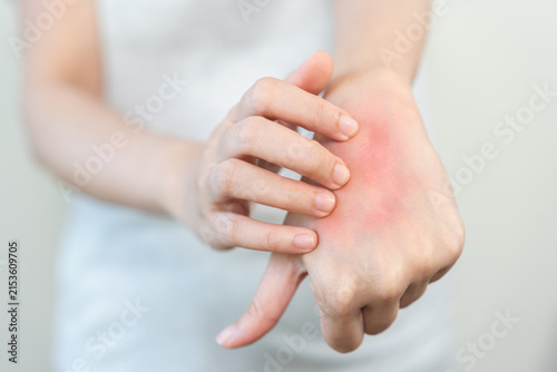 фотографія Dermatology asian young woman allergy, allergic reaction from atopic, insect bite, scratching itchy back of hand, red spot or rash of skin