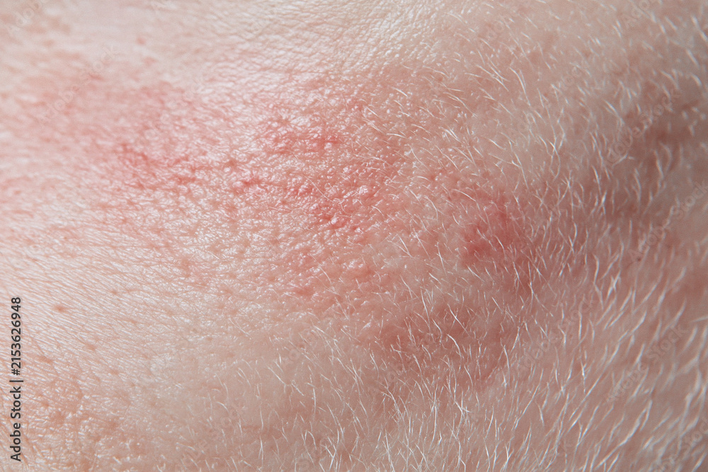 Fototapeta premium Red irritated skin close up with visible pores and fine hair, textured sensitive skin with mild redness and inflammation