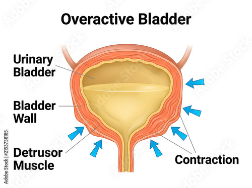 Overactive bladder with detrusor muscle contraction illustration isolated on white background