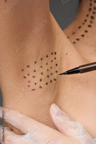 Foto Underarm sweating therapy preparation
