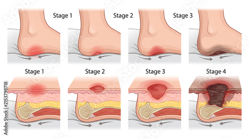 Four stages of pressure ulcer formation on human heel with pressure dermatology pathology necrosis infection clinical inflammation treatment condition ulceration