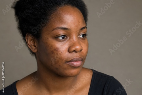 Post Acne Hyperpigmentation on Black Woman's Cheek
