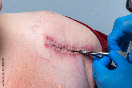 Quadro su tela Surgeon Removing Sutures from Healing Surgical Incision