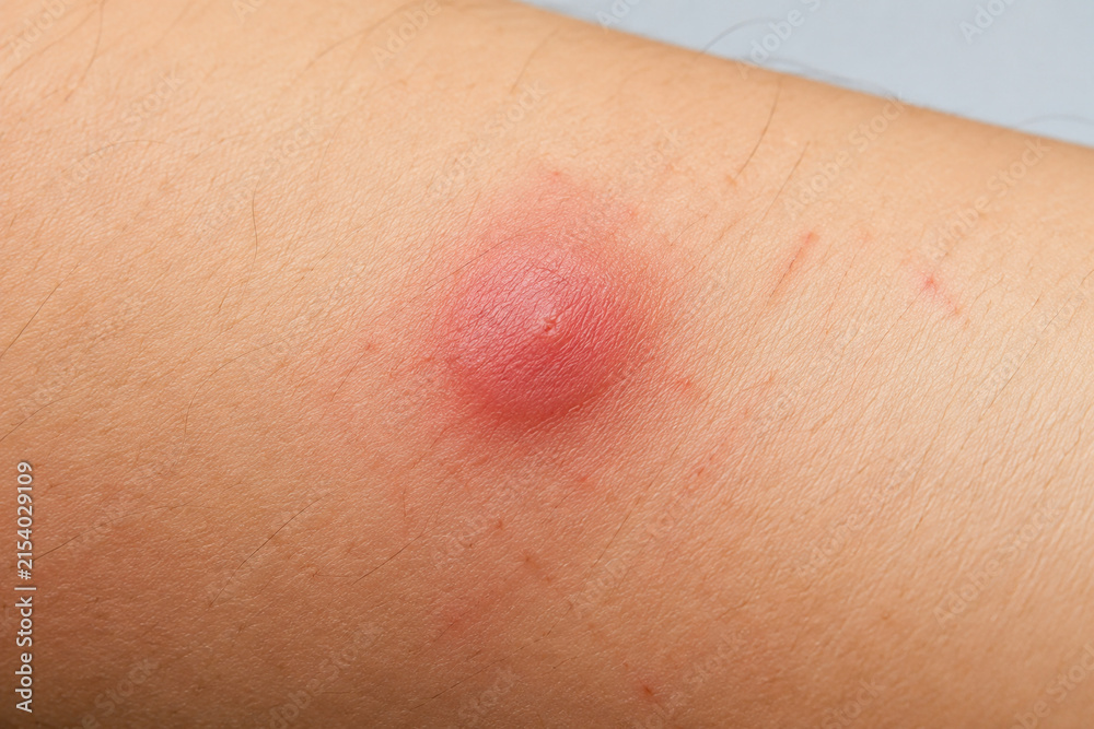 Fototapeta premium Red swollen mosquito bite on forearm skin, insect bite irritation and allergy