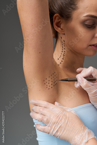 Fotografía Axillary hyperhidrosis botulinum toxin injection marking