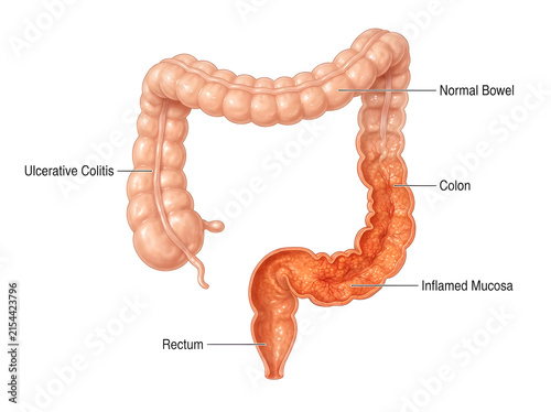 Ulcerative colitis illustration in human colon isolated on white background