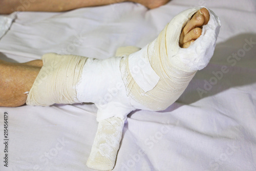 Foto Derotational Cast Boot on an Elderly Woman’s Leg for a Femur Fracture