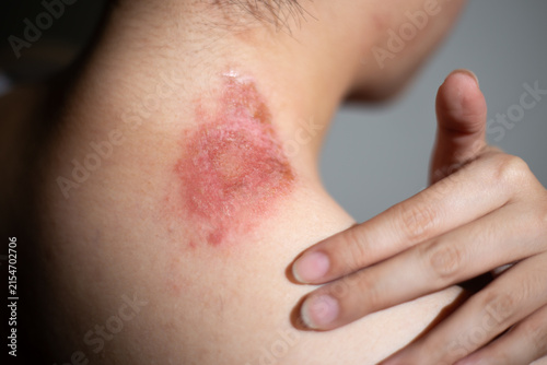 Medical close up of hand touching an itchy allergic irritated skin with a redness  insect bite rash on the neck.  