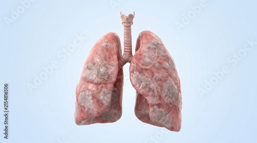 acute respiratory distress syndrome ARDS shown in premium clinical CGI with widespread bilateral inflammatory injury and pulmonary consolidation on a clean medical background.