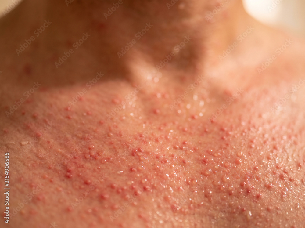 Fototapeta premium Miliaria Rubra Heat Rash Tiny Red Prickly Bumps on Adult Chest and Neck, Blocked Sweat Duct Skin Disease Macro Image