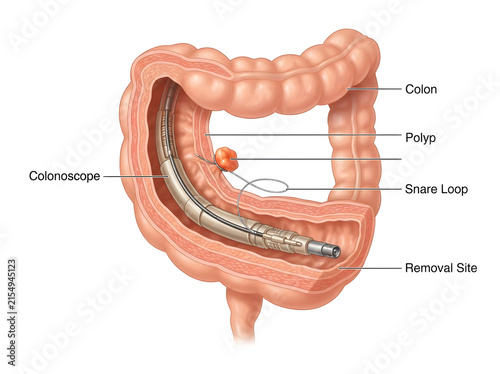 Colonoscopy showing polyp removal with snare loop isolated on white background