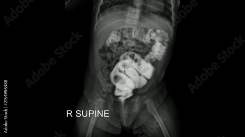 Supine abdominal radiograph during pediatric contrast enema examination demonstrating contrast opacification of the colon.