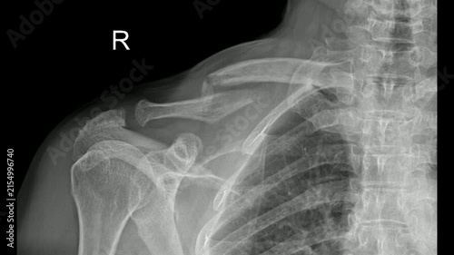 Right Humerus and Shoulder Joint Clavicle Fracture video