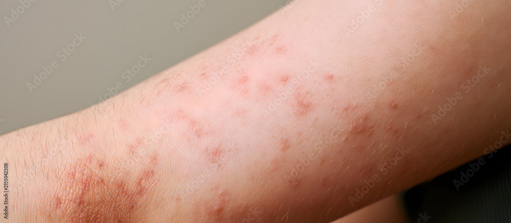 Fototapeta premium In a copy space image, a detailed depiction of eczema and atopic dermatitis skin conditions is presented