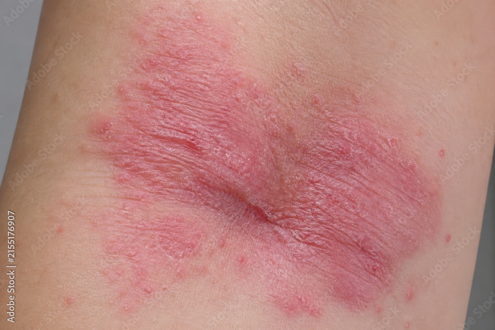Fototapeta premium Active Flexural Eczema-Like Dermatitis on Inner Elbow