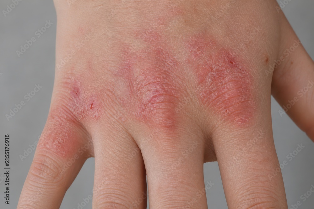 Fototapeta premium Active Eczema-Like Dermatitis on Back of Hand