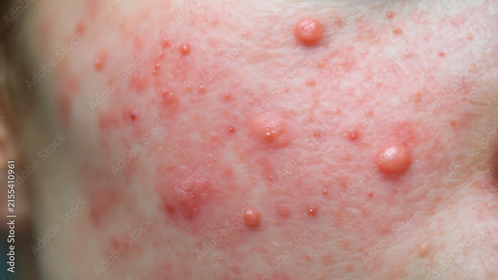 Fototapeta premium Close up view of human skin showing severe acne inflammation and red pimples on a person face