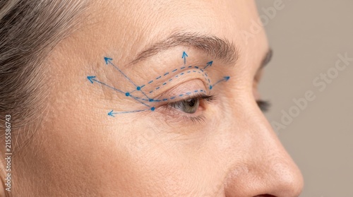 Side view macro of senior woman eye area with blue surgical markings for blepharoplasty and eye lifting procedure
