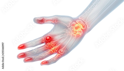 Medical Illustration of Painful Human Joints Showing Inflamed Wrist, Elbow and Knee Areas on transparent background