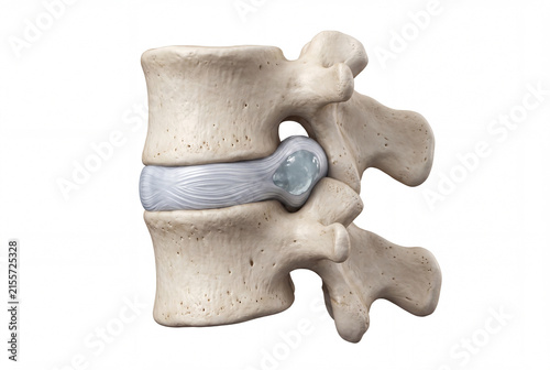 Fotografie Lumbar intervertebral disc with localized posterior disc protrusion
