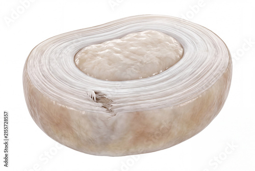 Fotografie Human intervertebral disc with localized annulus fibrosus tear