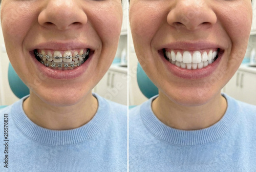 Closeup Of Dental Braces Transformation Illustrating Significant Smile Enhancement