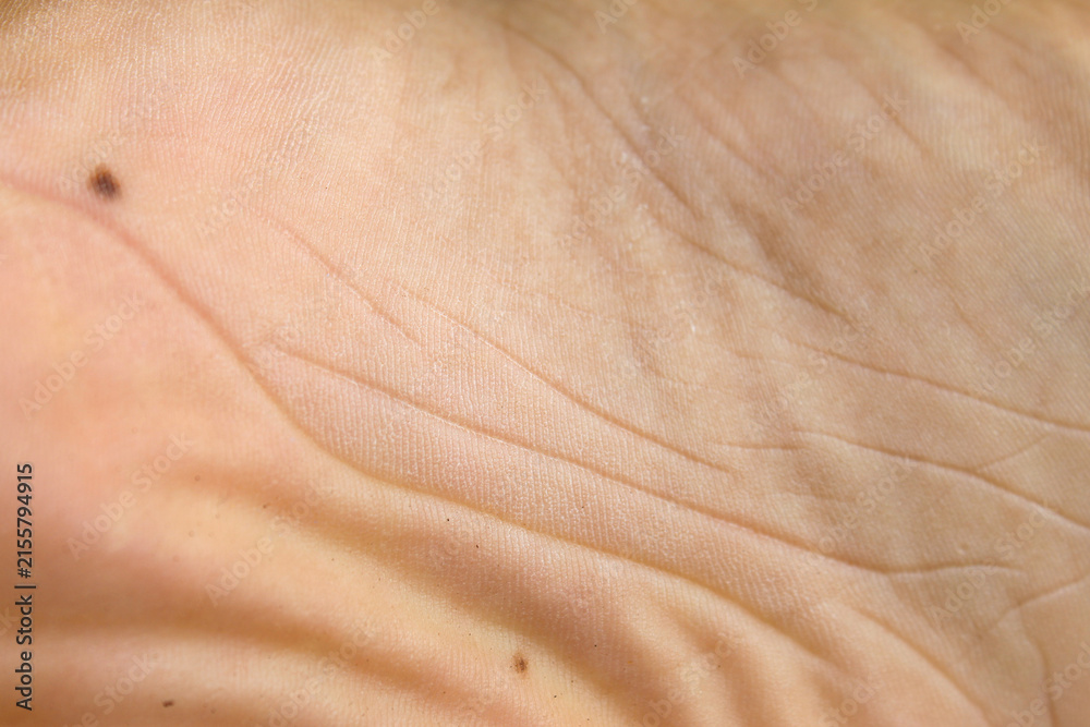 Fototapeta premium Mole or Black Nevus on the Skin of the Soles of the Feet