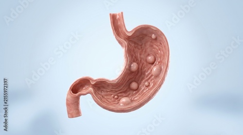 Gastric polyps shown in premium clinical CGI as multiple rounded growths projecting from stomach lining on a clean medical background