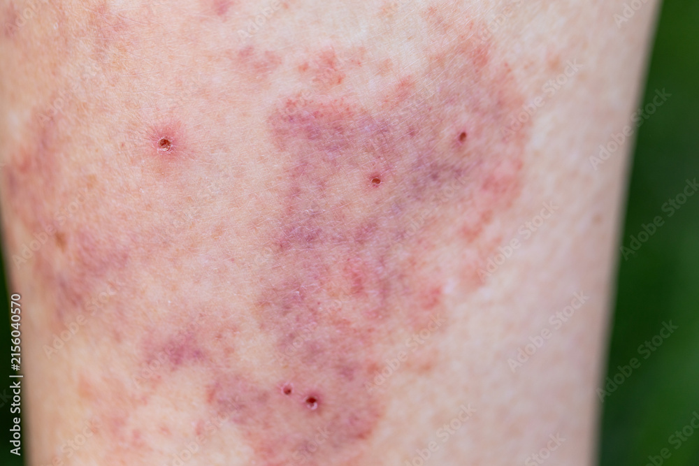 Fototapeta premium Extreme Close-Up of Bruised Skin with Red Spots and Small Scabs